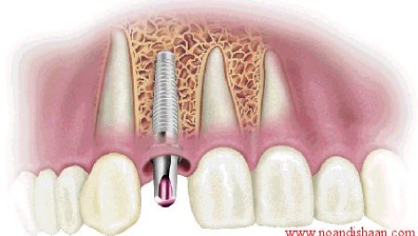 ايمپلنت دنداني