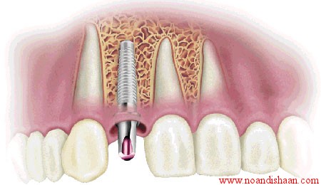 ايمپلنت دنداني