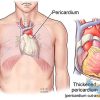 بررسی آناتومیک پریکارد قلب