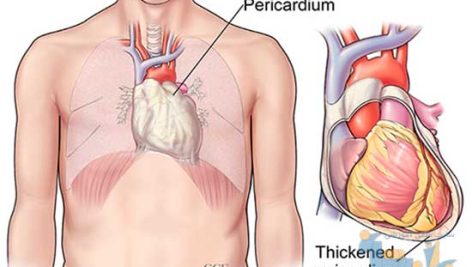 بررسی آناتومیک پریکارد قلب