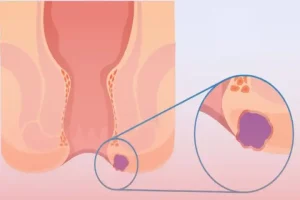 آیا آبسه مقعدی خطرناک است