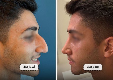 جراحی بینی در تهران با پزشک 24